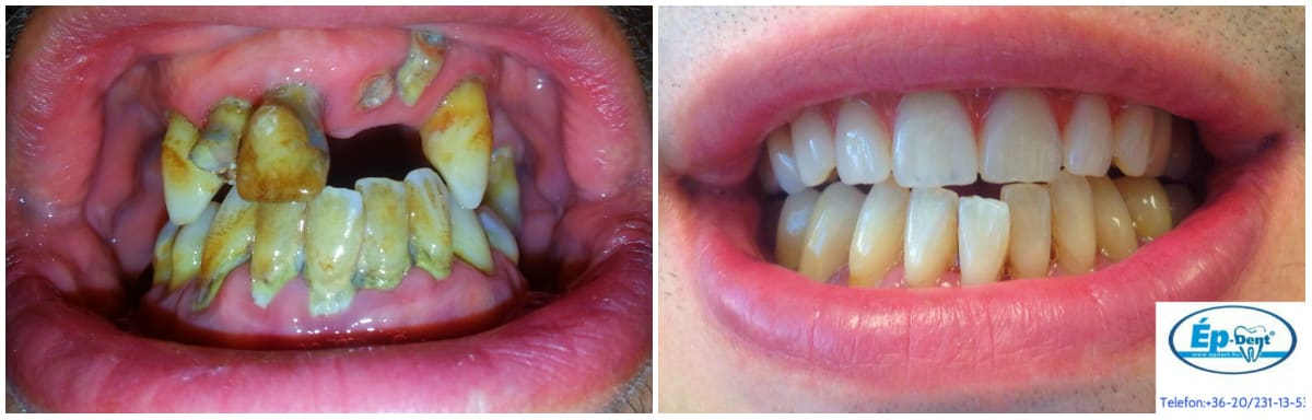 A fogászati implantátumok problémái - 8 figyelmeztető tünet